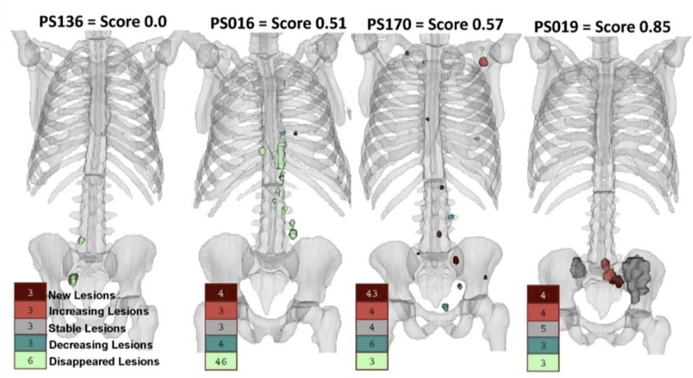 Application of a novel #MachineLearning model in 68Ga-PSMA-11 PET/CT – predicting survival in oligometastatic #ProstateCancer patients. Presented by @MikaelaDellOro @UWAresearch. #ESMO23 written coverage by @zklaassen_md @GACancerCenter > bit.ly/498jhXW @myESMO