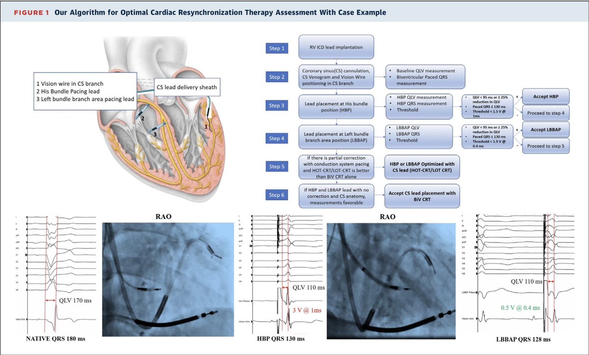 Thoughts 💭: APAA (As Physiological As Achievable) Principle Shared Algorithm for Cardiac Resynchronization in Patients With LBBB/IVCD Pattern Ravi @SharathVippart1 Sanders @hhuang123 Larsen Trohman @Hisdoc1 @psharmadoc cited doi.org/10.1016/j.jace… @JACCJournals