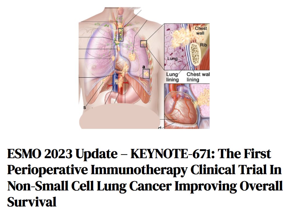 BTFCancerNews's tweet photo. The Cancer News has many updates from #ESMO2023 like this one on KEYNOTE-671 from @LeiDeng3 ⬇️
https://t.co/wPyuQJa1ZJ
#ESMO #cancer #cancernews #Oncology #oncologynews #lungcancer #KEYNOTE671 https://t.co/dhdCuD2NfM