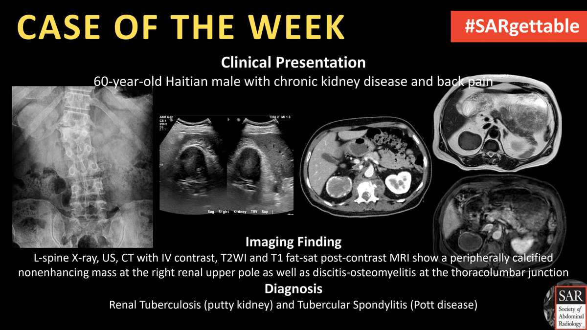 The answer to last week's #SARgettable Case of the Week, submitted by @kchang, is: Renal Tuberculosis (putty kidney) and Tubercular Spondylitis (Pott disease). Thanks for playing!