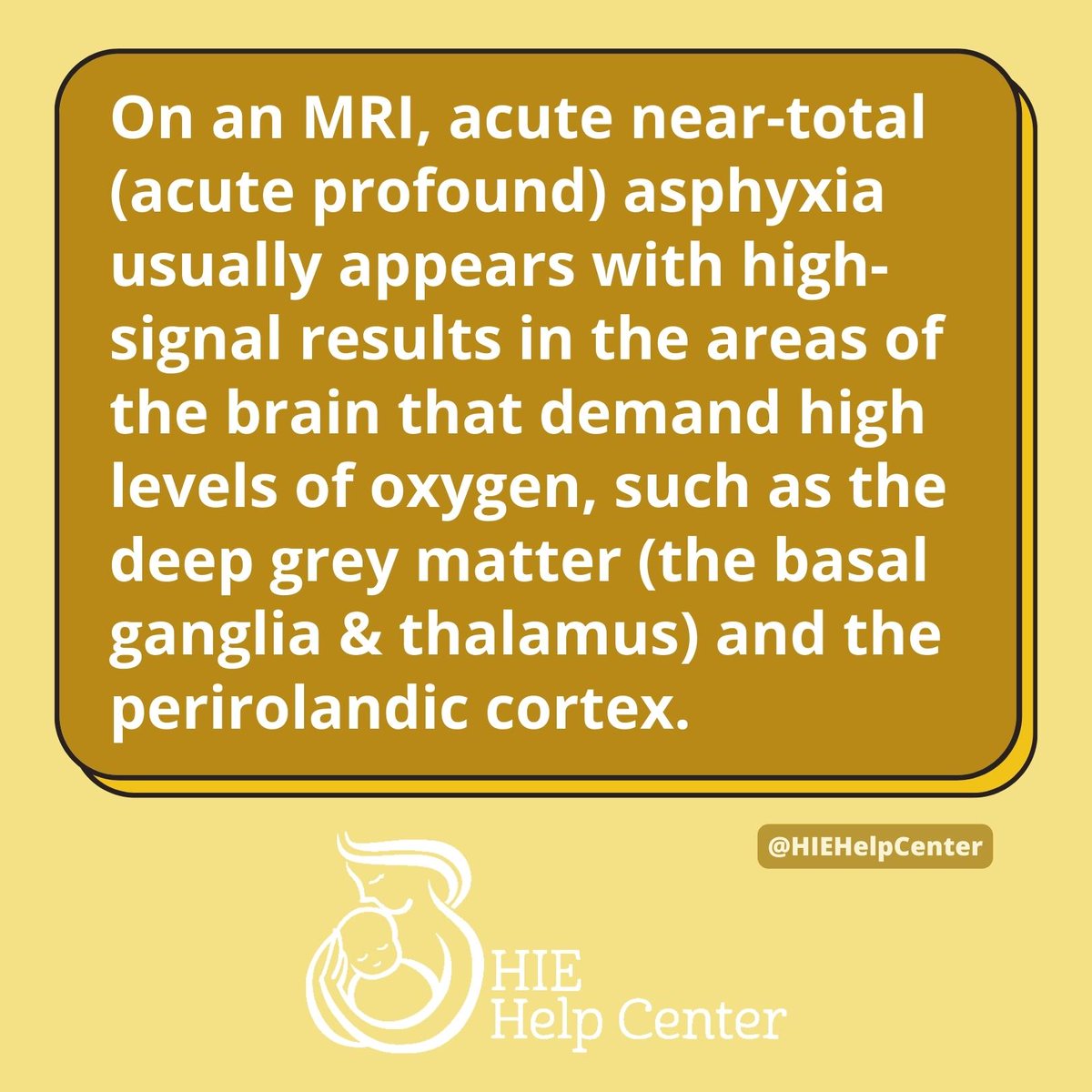 What is acute profound asphyxia?

hiehelpcenter.org/medical/identi… #BirthAsphyxia #birthinjury (1/2)