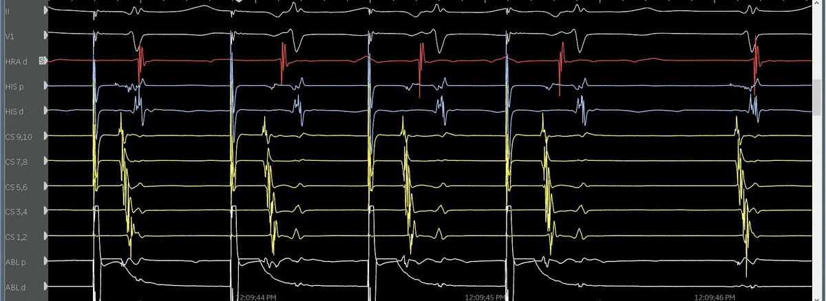 #EPeeps Is it possible to capture / conceal into slow pathway? Are there other explanations for what’s happening here? No lines of block in atrium. Pacing from abl at 4 o’clock at 10mA on TA. #PMA @syamkumarmd @forkknifecab_EP
