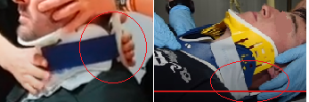 Frantxu_M's tweet photo. @Tecnico_ambu ¿Que forma? En circunferencia que es su forma final de colocarlo? Cuando se habla de problemas al colocarlo, ¿a cual te refieres? A los de la imagen?  Precisamente esos problemas derivan por su forma plana de guardar y no dar forma a la hora de colocarlo. https://t.co/CjxxuC42F5