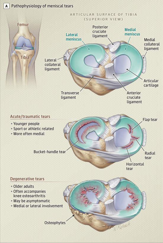 La Trobe SEMRC (@latrobesem) on Twitter photo ICYMI: <a href="/JAMA_current/">JAMA</a> just published a one-stop shop for knee OA, patellofemoral pain & meniscal injuries ๐
Bravo <a href="/agculvenor/">Adam Culvenor</a>, <a href="/vickyduong/">vicky duong</a> & <a href="/ProfDavidHunter/">ProfDavidHunter</a>!
jamanetwork.com/journals/jama/โฆ
#knee #OA #meniscal #injury ICYMI: <a href="/JAMA_current/">JAMA</a> just published a one-stop shop for knee OA, patellofemoral pain & meniscal injuries ๐
Bravo <a href="/agculvenor/">Adam Culvenor</a>, <a href="/vickyduong/">vicky duong</a> & <a href="/ProfDavidHunter/">ProfDavidHunter</a>!
jamanetwork.com/journals/jama/โฆ
#knee #OA #meniscal #injury