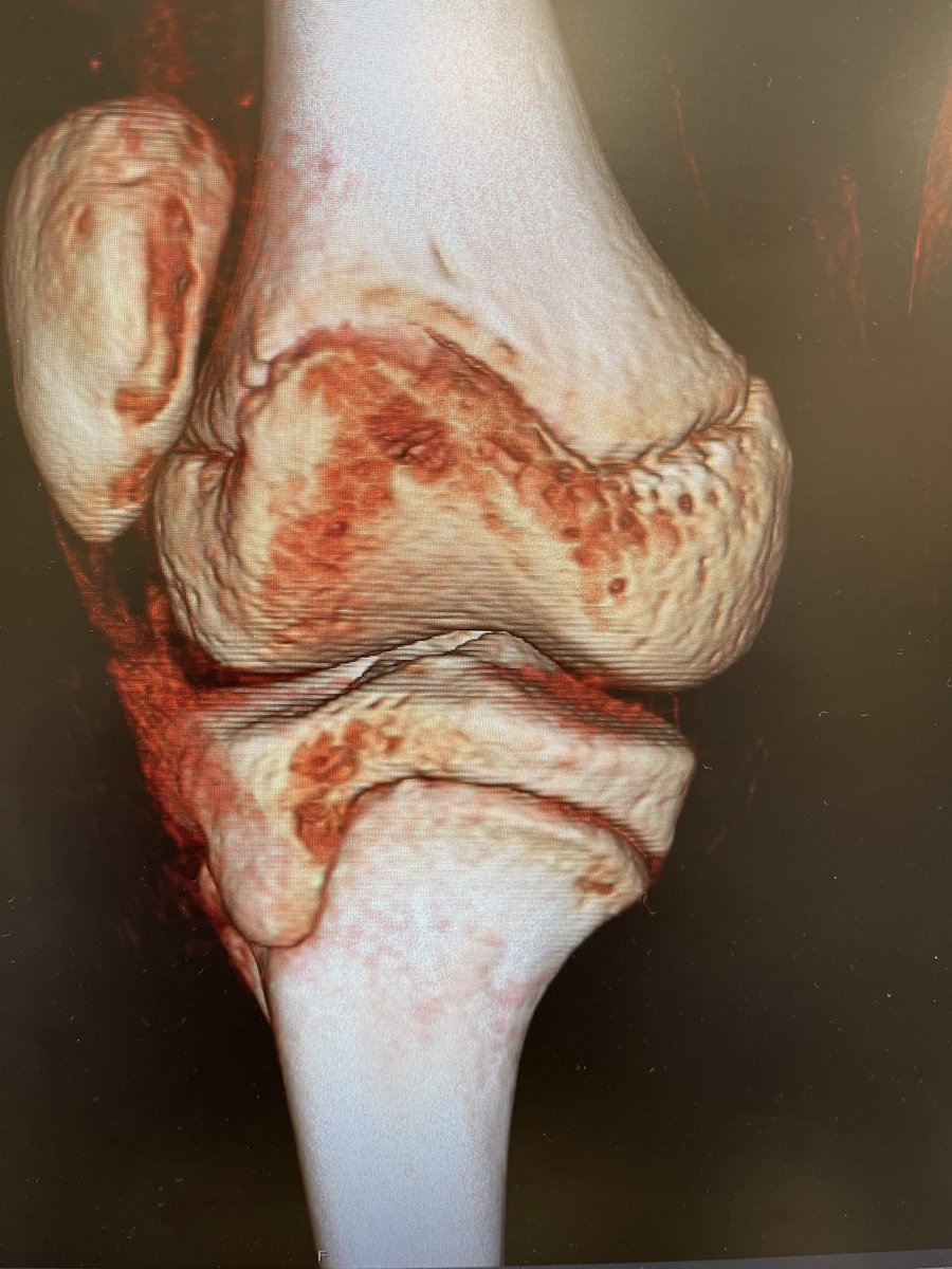 3D helps establish goals. Tough case with epiphyses open and tubercle lateral. Fortunately a reasonable recipient trochlea and no alta. Considerable lateral release, Grammont and precise medial complex recon most likely in this skeletal immature patient