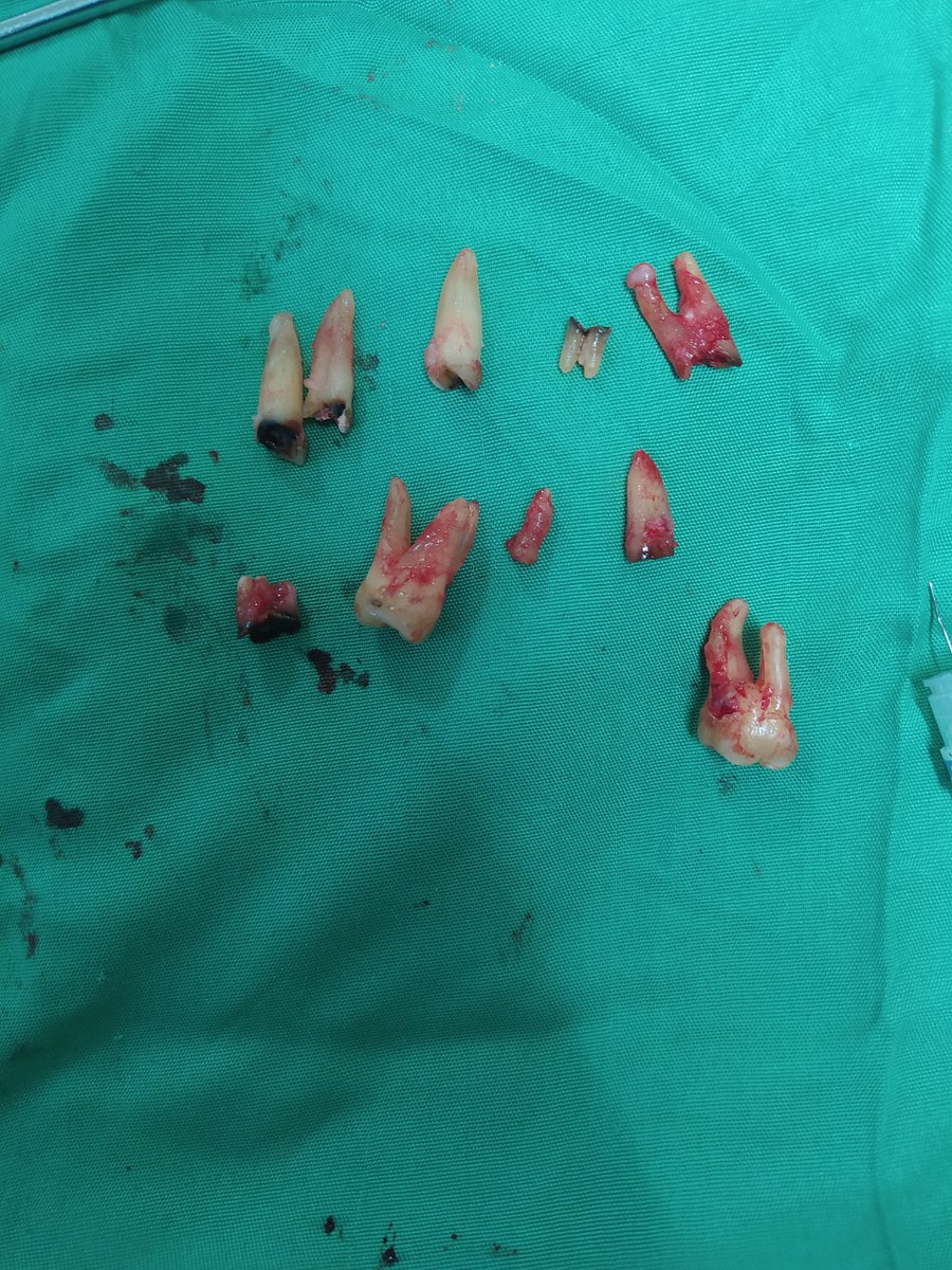 el_maximo_pedro's tweet photo. hoy toco hacer zafra😂
perfecto día en cirugía 💪🏻🦷 https://t.co/5KauhnCwKo