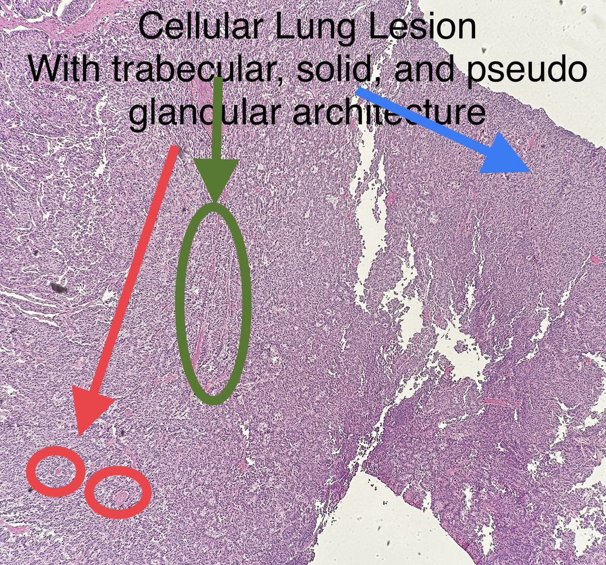 Path4People's tweet image. Central Lung 🫁 Nodule, 3 cm

IHC: 
Positive for Synaptophysin, INSM-1, Ki-67 12%. 

(Negative for necrosis and Mitotic count &amp;lt; 2/2 mm^2)

Dx?

Credit: Dr. M. Pokorney
#pathagonia #pathx #pulm #medx #surgx #ctsurgery #neuroendocrine #medstudentx #pulmonology #surgery #hemonc