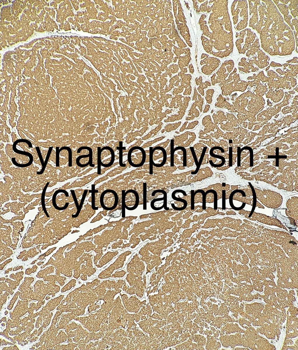 Path4People's tweet image. Central Lung 🫁 Nodule, 3 cm

IHC: 
Positive for Synaptophysin, INSM-1, Ki-67 12%. 

(Negative for necrosis and Mitotic count &amp;lt; 2/2 mm^2)

Dx?

Credit: Dr. M. Pokorney
#pathagonia #pathx #pulm #medx #surgx #ctsurgery #neuroendocrine #medstudentx #pulmonology #surgery #hemonc