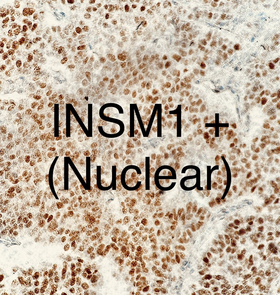 Path4People's tweet image. Central Lung 🫁 Nodule, 3 cm

IHC: 
Positive for Synaptophysin, INSM-1, Ki-67 12%. 

(Negative for necrosis and Mitotic count &amp;lt; 2/2 mm^2)

Dx?

Credit: Dr. M. Pokorney
#pathagonia #pathx #pulm #medx #surgx #ctsurgery #neuroendocrine #medstudentx #pulmonology #surgery #hemonc