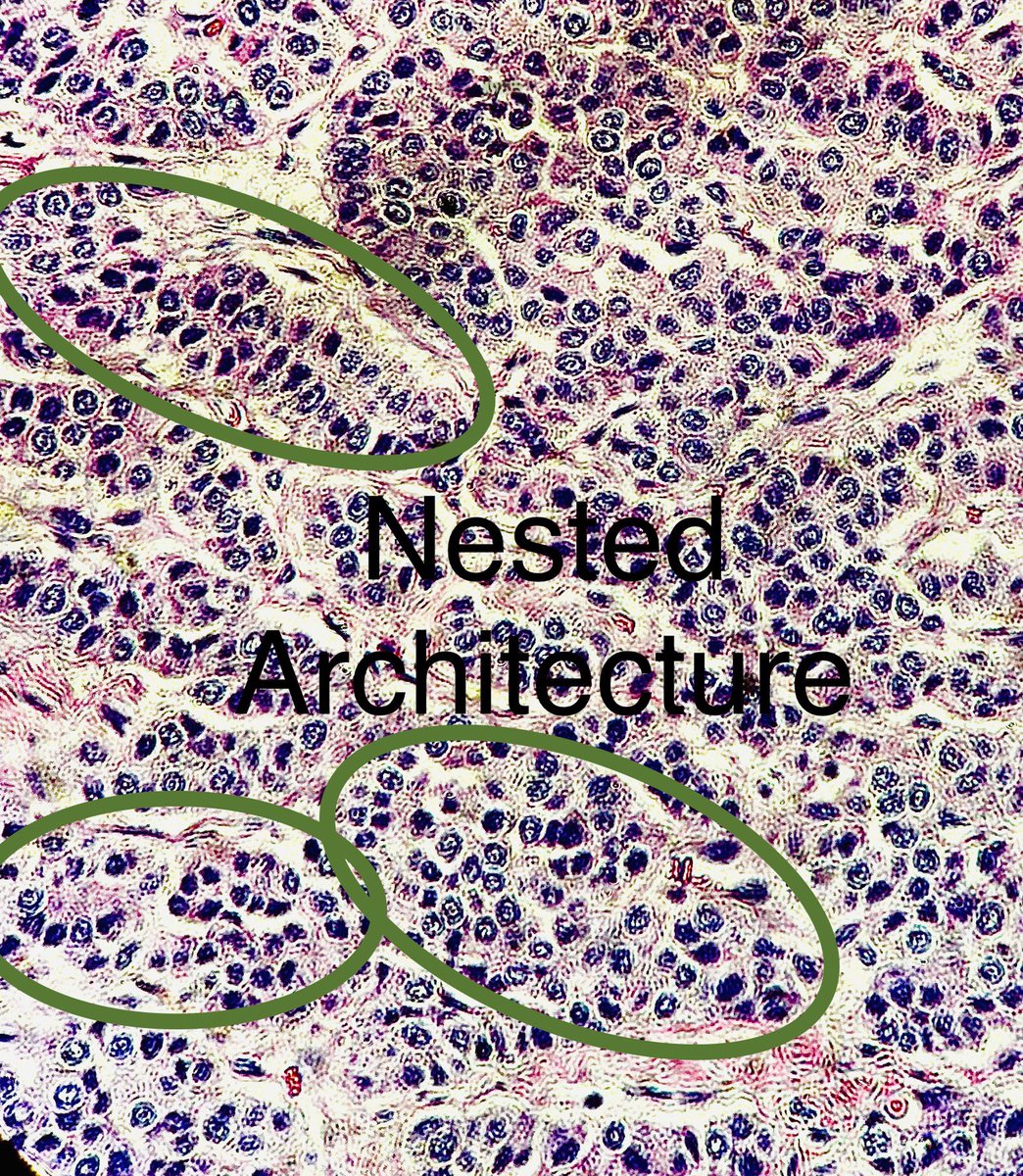 Path4People's tweet image. Central Lung 🫁 Nodule, 3 cm

IHC: 
Positive for Synaptophysin, INSM-1, Ki-67 12%. 

(Negative for necrosis and Mitotic count &amp;lt; 2/2 mm^2)

Dx?

Credit: Dr. M. Pokorney
#pathagonia #pathx #pulm #medx #surgx #ctsurgery #neuroendocrine #medstudentx #pulmonology #surgery #hemonc