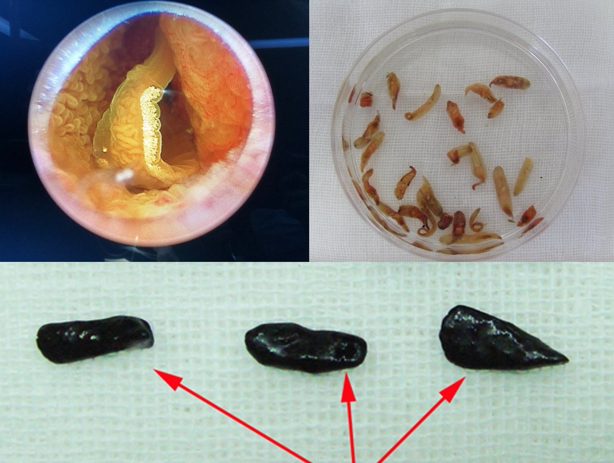Journal of Helminthology on X: Clonorchis sinensis is a liver fluke that  you can get from eating raw freshwater fish. In this study, researchers  examined some odd-looking gallbladder stones that turned out