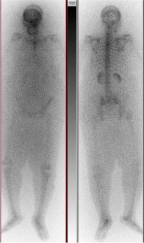 NuclearMD's tweet photo. What is the best explanation of the findings on this bone scan? https://t.co/mXHuP8wTnH