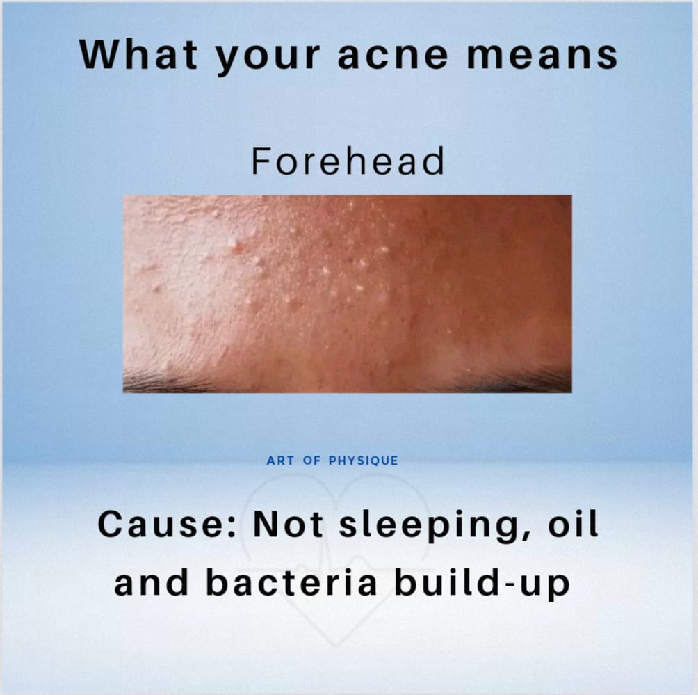 What your acne means and the causes... 1. Forehead