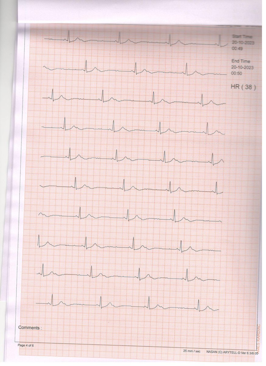 Suchit Majumdar (@suchitmajumder) on Twitter photo 23 yr man with weakness and dizziness mostly in evening hours- often noticed his HR low by pulse oximeter. 
Normal echo. What can be done for the holter findings? <a href="/UlhasDr/">Dr Ulhas Pandurangi</a> <a href="/manak_18/">Deepak Padmanabhan</a> <a href="/abhishek_mbbs/">Abhishek</a> <a href="/DCR_Dr/">Deep Chandh Raja</a> 23 yr man with weakness and dizziness mostly in evening hours- often noticed his HR low by pulse oximeter. 
Normal echo. What can be done for the holter findings? <a href="/UlhasDr/">Dr Ulhas Pandurangi</a> <a href="/manak_18/">Deepak Padmanabhan</a> <a href="/abhishek_mbbs/">Abhishek</a> <a href="/DCR_Dr/">Deep Chandh Raja</a>