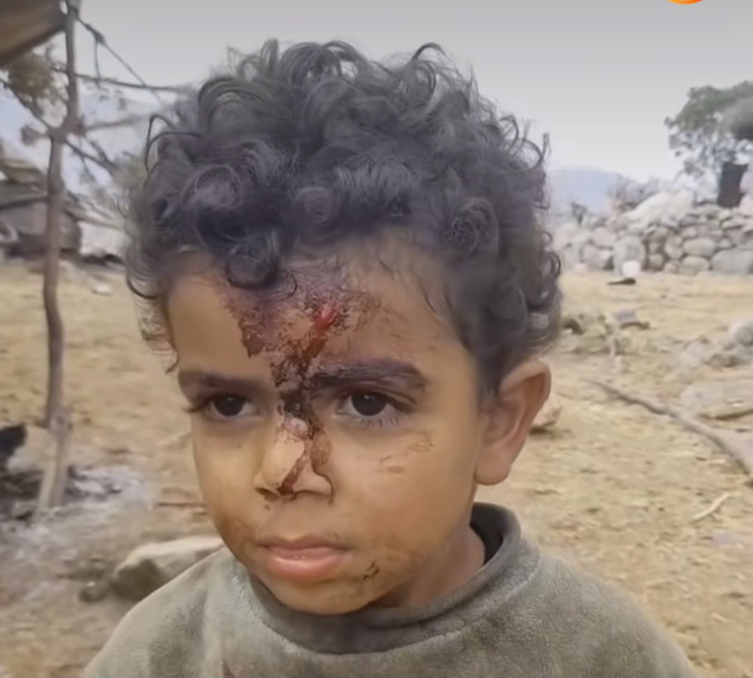 این کودک ساکن انجیرستان است. از اهالی سوسن غربی در شهرستان ایذه. به دلیل نبود امکانات پزشکی و درمانی، آن‌قدر خون از سرش رفته که خودش بند آمده است‌. گفتند و خواستند صدایش باشم.