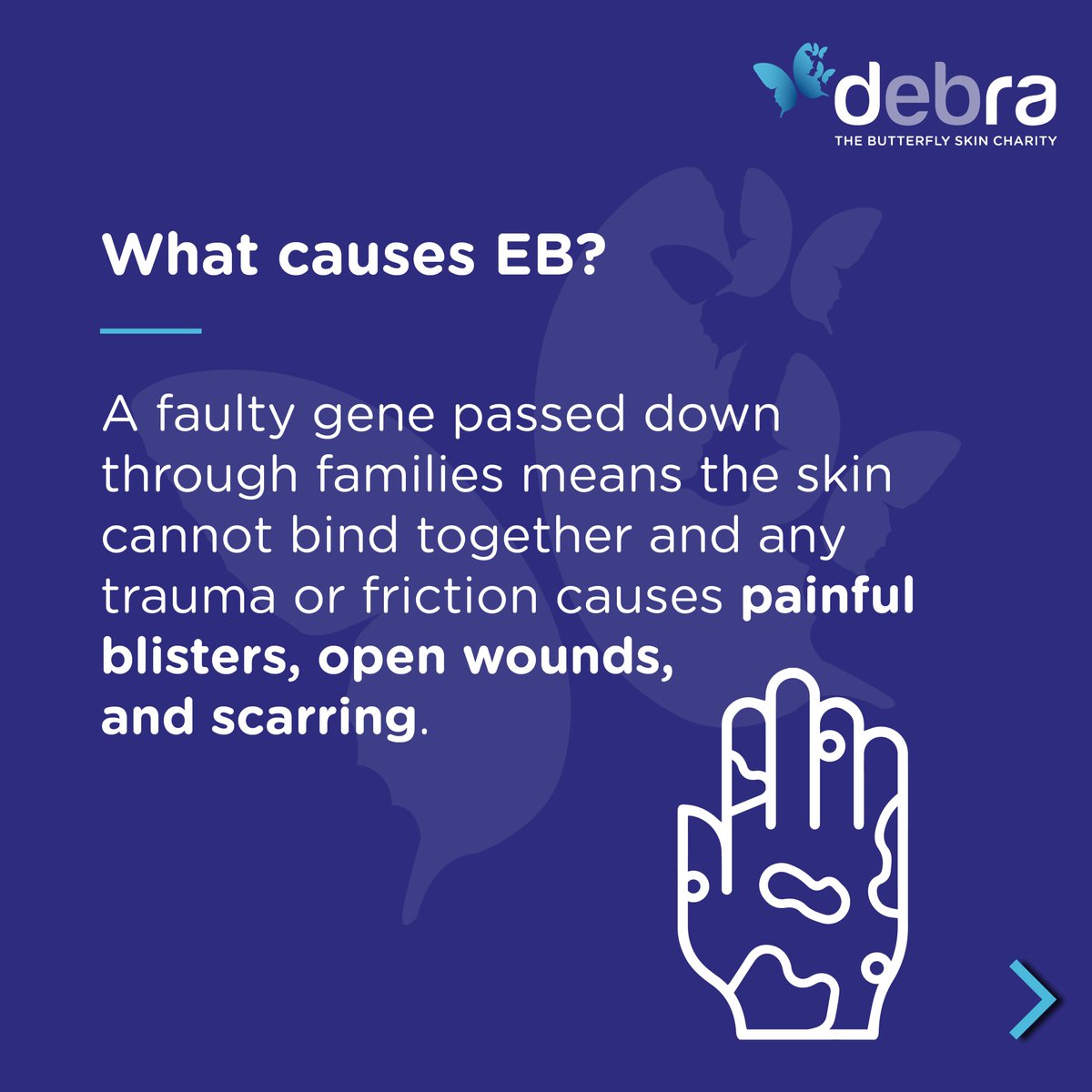 CharityDEBRA's tweet photo. #EBAwarenessWeek is here! A week dedicated to increasing awareness of the incredibly painful genetic skin blistering condition, epidermolysis bullosa (EB).
Please RT this post and help us raise awareness.
Find out more about EB: https://t.co/20v24JkWon
#EBAwarenessWeek2023 https://t.co/H8EMaErXeL