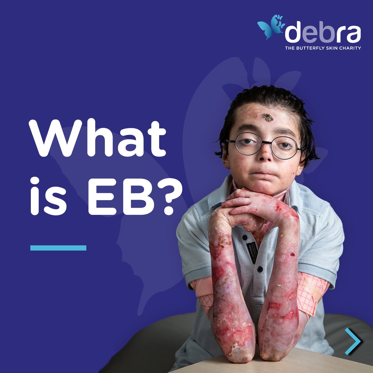 CharityDEBRA's tweet photo. #EBAwarenessWeek is here! A week dedicated to increasing awareness of the incredibly painful genetic skin blistering condition, epidermolysis bullosa (EB).
Please RT this post and help us raise awareness.
Find out more about EB: https://t.co/20v24JkWon
#EBAwarenessWeek2023 https://t.co/H8EMaErXeL