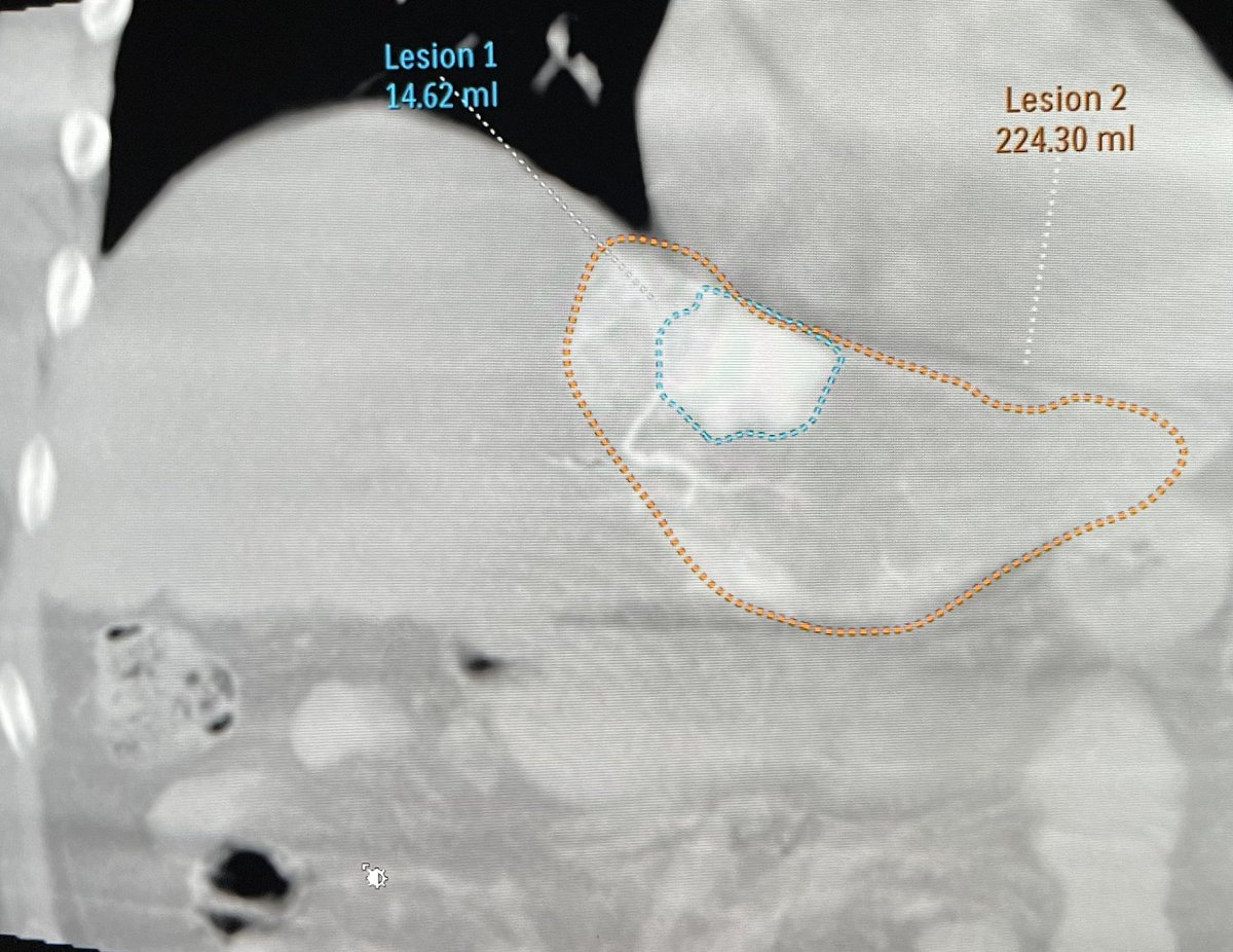 ahmed_kamel_ir's tweet photo. #Hepatocellular #carcinoma treated with Y90 #radioembolization (450 Gy dose). Follow up showing complete response by #mRECIST #InterventionalRadiology #HCC #MinimalInvasiveTreatment #Cancer #GlobalEducation #ResidencyEducation #LocoRegionalTherapy #byebyetumor https://t.co/5KnRTsXgJW
