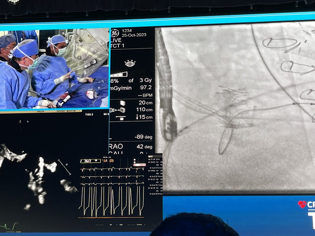 mirvatalasnag's tweet photo. #TCT2023 @crfheart 
Live case #MViV

@MayraGuerreroMD 
Dilate septum for comfort

Mind the delivery sheath & pusher to maintain position (don’t pull it too far back so the markers at the distal edge)

Go atrial by pushing wire

Mind the skirt & w the ultra @EdwardsLifesci THV u can be higher w their skirt