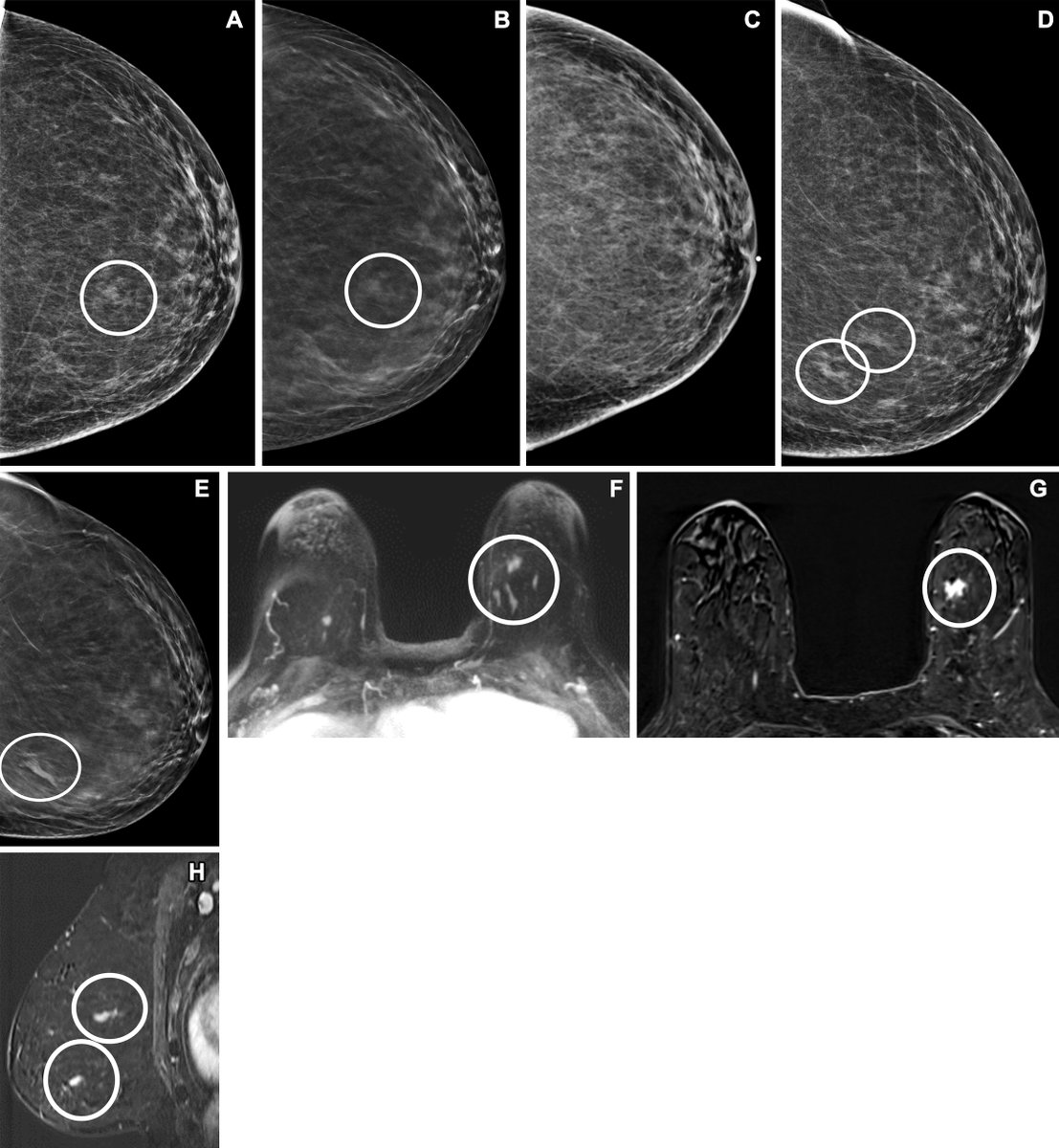 In women with dense breast tissue who may be at increased risk of breast cancer, digital breast tomosynthesis and supplemental screening with US, MRI, or contrast-enhanced mammography can improve cancer detection. @AnnBrownMD @CharmiMD @mitvamd @RifatWahab bit.ly/40drPsB