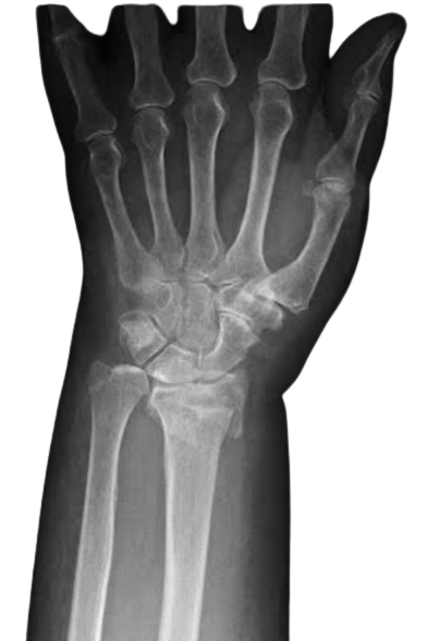 HealthinnTech's tweet photo. Las 1⃣5⃣ complicaciones más comunes tras una #Fractura de Radio Distal💥

📊Se estima que entre el 21-27% de las Fx de Radio sufren de eventos inesperados que frenan su recuperación

¿Las conoces todas? ¿Y las más frecuentes?⬇️🔎 https://t.co/AV0f7CNJRj