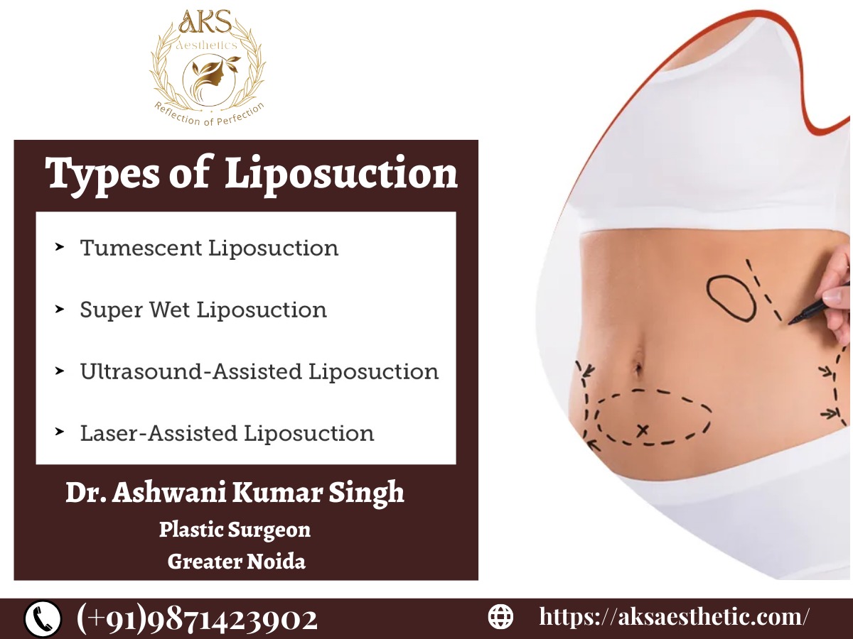AestheticAks's tweet photo. Types of Liposuction: π
π Tumescent Liposuction
π Super Wet Liposuction
π Ultrasound-Assisted Liposuction
π Laser-Assisted Liposuction
Consult Dr. Ashwani Kumar, Best Liposuction Surgeon in Noida/Greater Noida
π Phone: 9871423902.
#liposuction #types #typesofliposuction https://t.co/mRSv9SDEBD