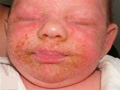 JournalofDerma1's tweet photo. 🔬Roflumilast foam, a novel and targeted treatment, has shown incredible potential in clinical trials for Seborrheic Dermatitis, a common skin condition that causes redness, itching, and flaking, primarily affecting the scalp, face, and other oily areas.
#Dermatology #Seborrheic https://t.co/JUs7Grr0qK