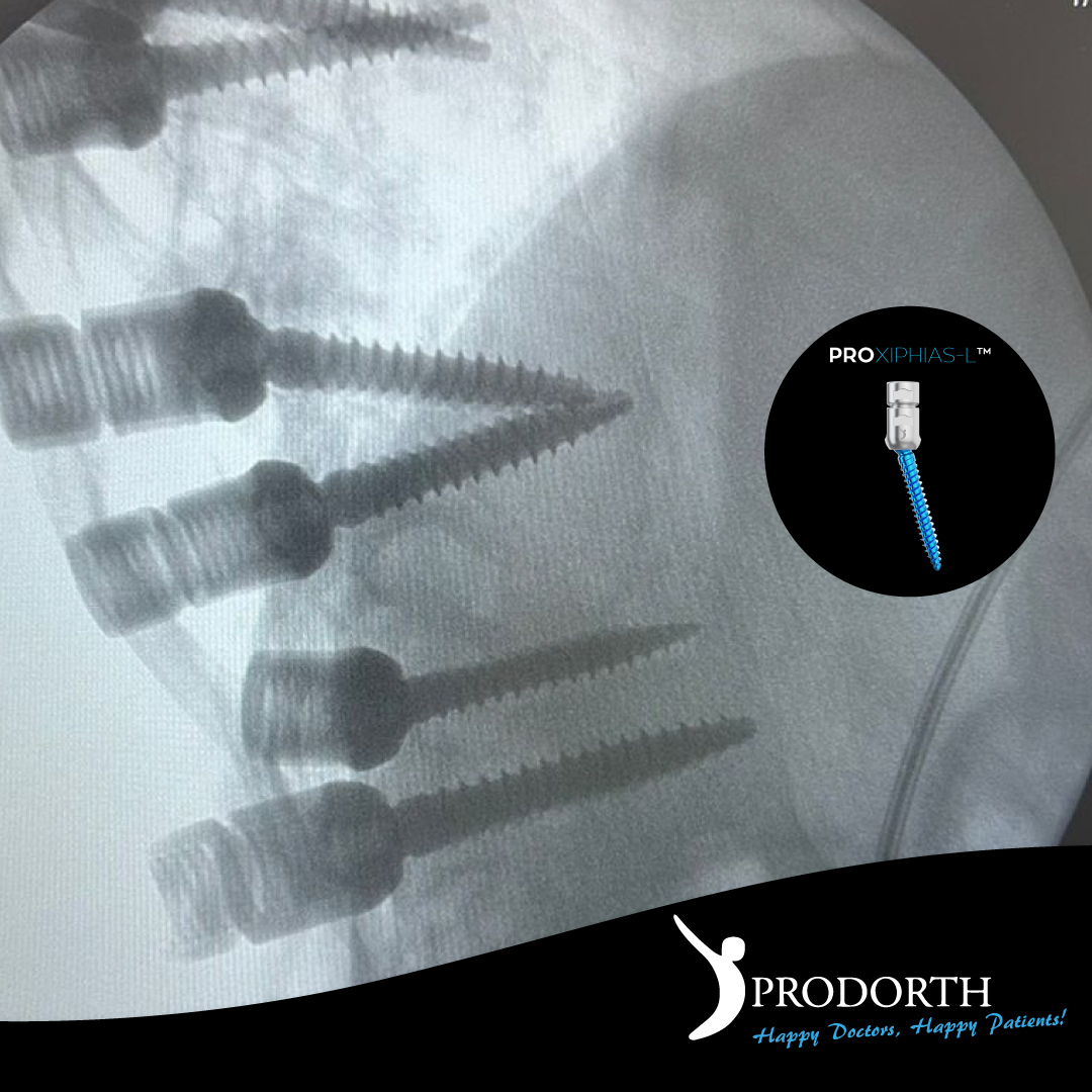 🎯 Posterior Fixation Systems
🎯 Listhesis Pedicular Screws

PROXIPHIAS-L™️

📍 Republic of Colombia 🇨🇴

#prodorthspine #spinehealth #spinesurgery #spinedoctor #spinedevice #spineimplants #surgeryinstruments #spinesurgeryinstruments #thoracolumbarfusion #pediclescrew