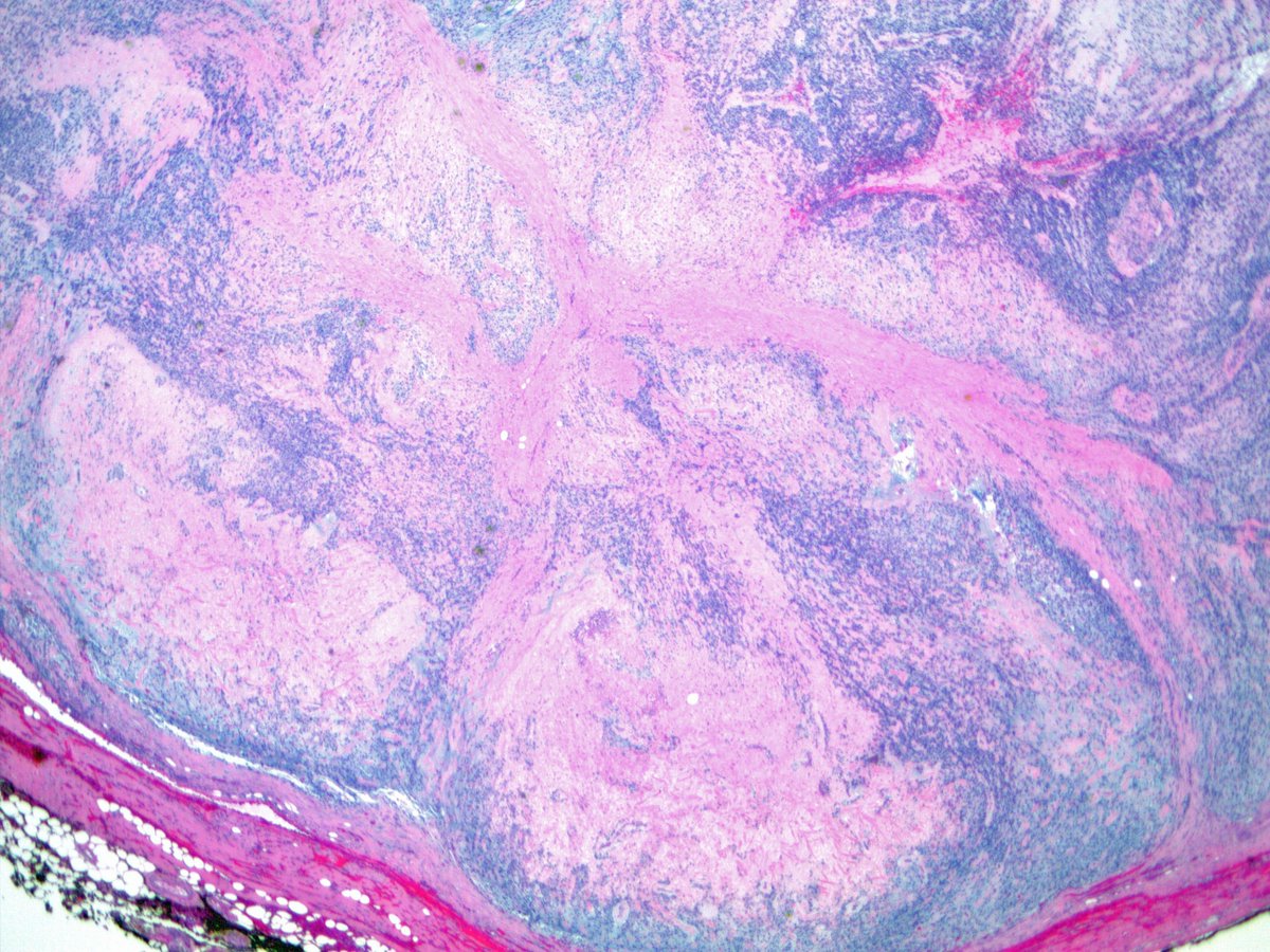ScottBikeethan's tweet photo. 45 year-old-male with a destructive right posterior mandibular mass. Based solely on these features, what is the most likely diagnosis? And why? #BSTpath #sarcoma @CCFPathRes @CLEClinicLabs https://t.co/7CTwTMOcHa
