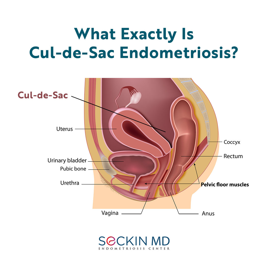 Learn more about cul-de-sac #endometriosis and how you can make a difference in raising awareness drseckin.com/what-exactly-i… #CulDeSacEndometriosisStories #culdesac #EndometriosisAwareness #ShareYourStory #CommunitySupport