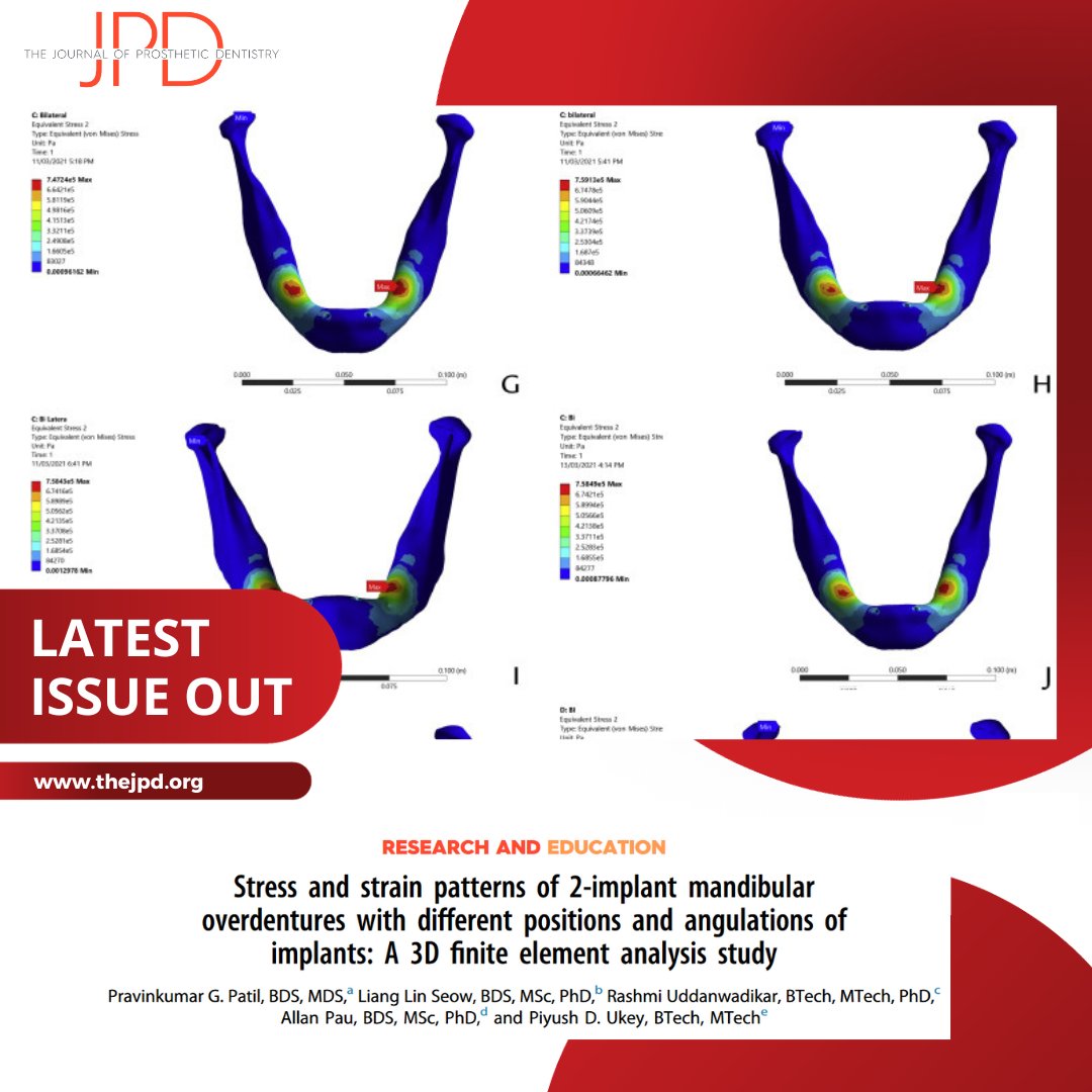 JPDentistry's tweet image. The latest issue of #theJPD features this #finiteelementanalysis study evaluating the stress and strain when utilizing stud attachment #denture retention at various angles and locations in the mandible: thejpd.org/article/S0022-…