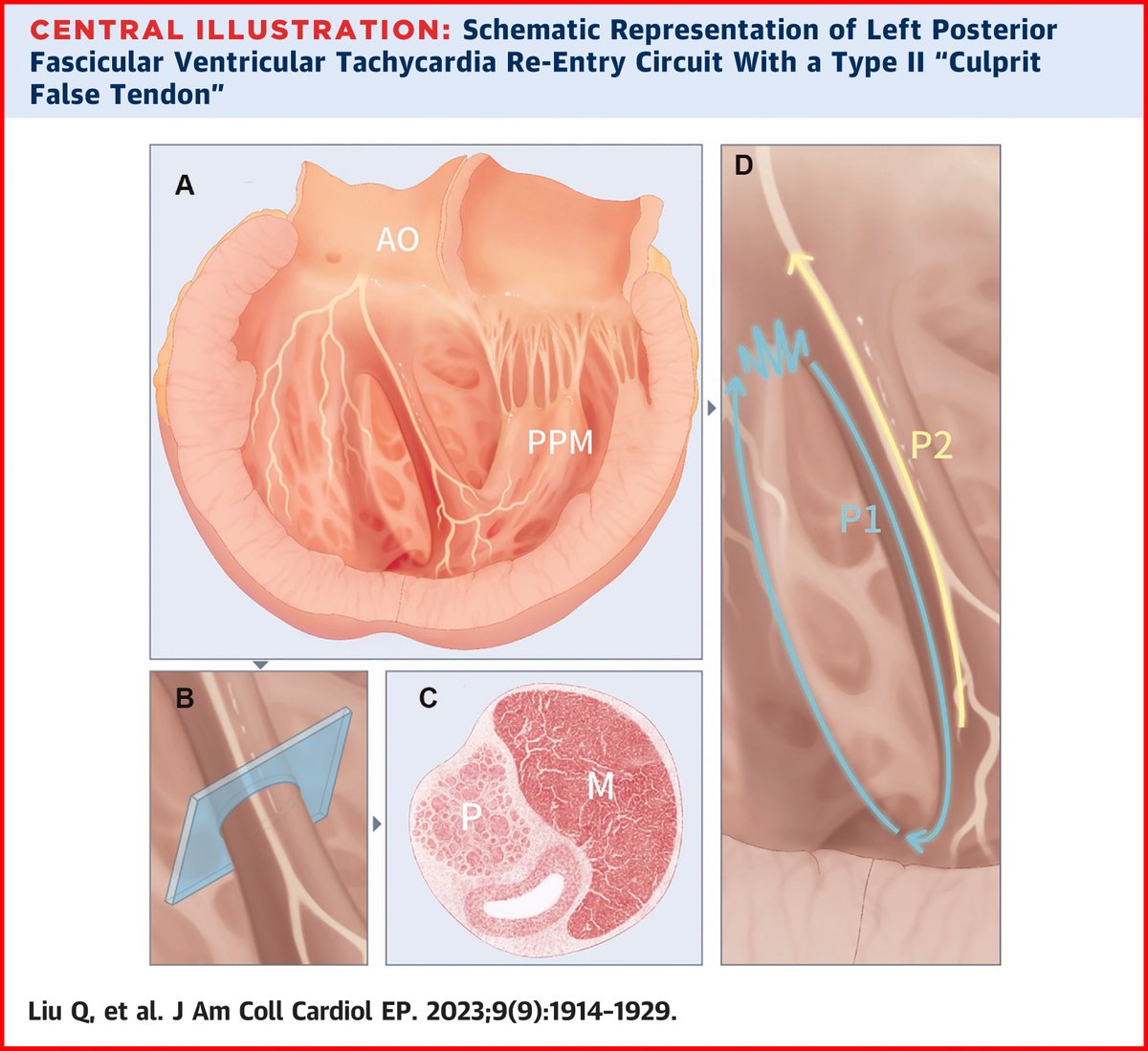 JACCJournals's tweet photo. The electroanatomical substrate for left posterior fascicular ventricular tachycardias (LPF-VT) - are false tendon connections the missing "links"? Detailed recordings from false tendons during LPF-VT guided by ICE ➡️ https://t.co/CTfDmR0BPb

#JACCCEP #AblateVT #Epeeps #EPAnatomy https://t.co/hT6k3eMyVJ