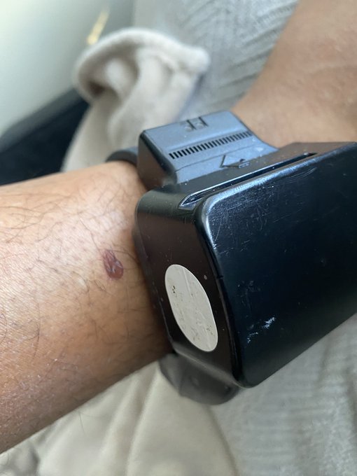 On blood thinner medication we see that leather ah cut chu. In a life threatening emergency it&rsquo;s still<a href="/tag/slr"class="tags"><span>#slr</span></a>