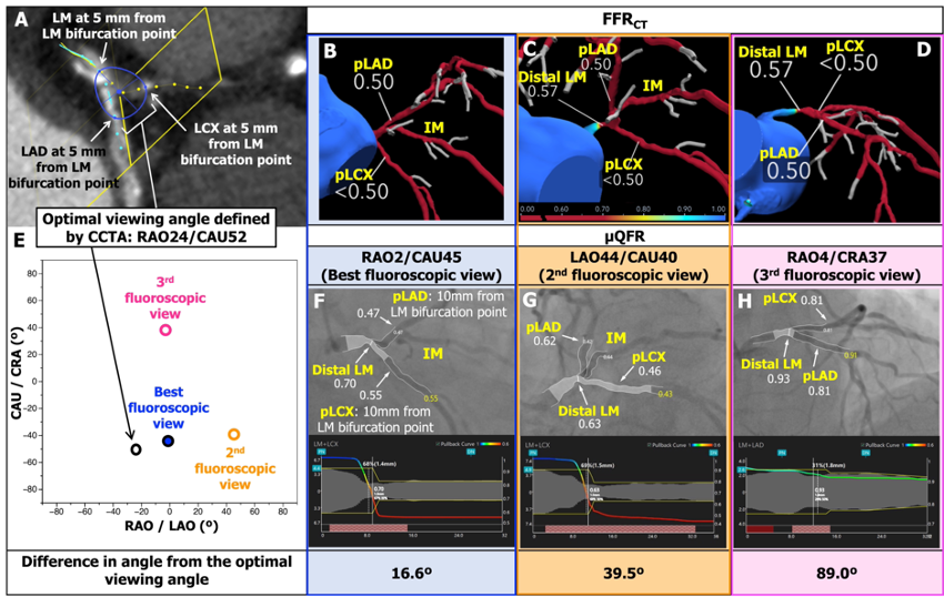 We are delighted to share our findings with you!😊 Murray law-based quantitative flow ratio to assess left main bifurcation stenosis: selecting the angiographic projection matters. Int J Cardiovasc Imaging (2023). Kotoku, Ninomiya, Ding, Serruys et al. doi.org/10.1007/s10554…