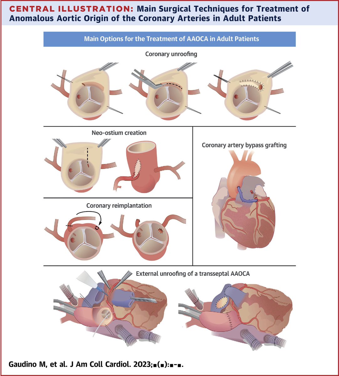 @JACCJournals Answer: Single coronary with anomalous LM arising from the RCA with a transseptal/subpulmonic course and a long intramyocardial segment. Given recurrent CP, pt underwent external unroofing. Avoid CABG alone in pts w/ good forward flow due to high likelihood of graft failure.