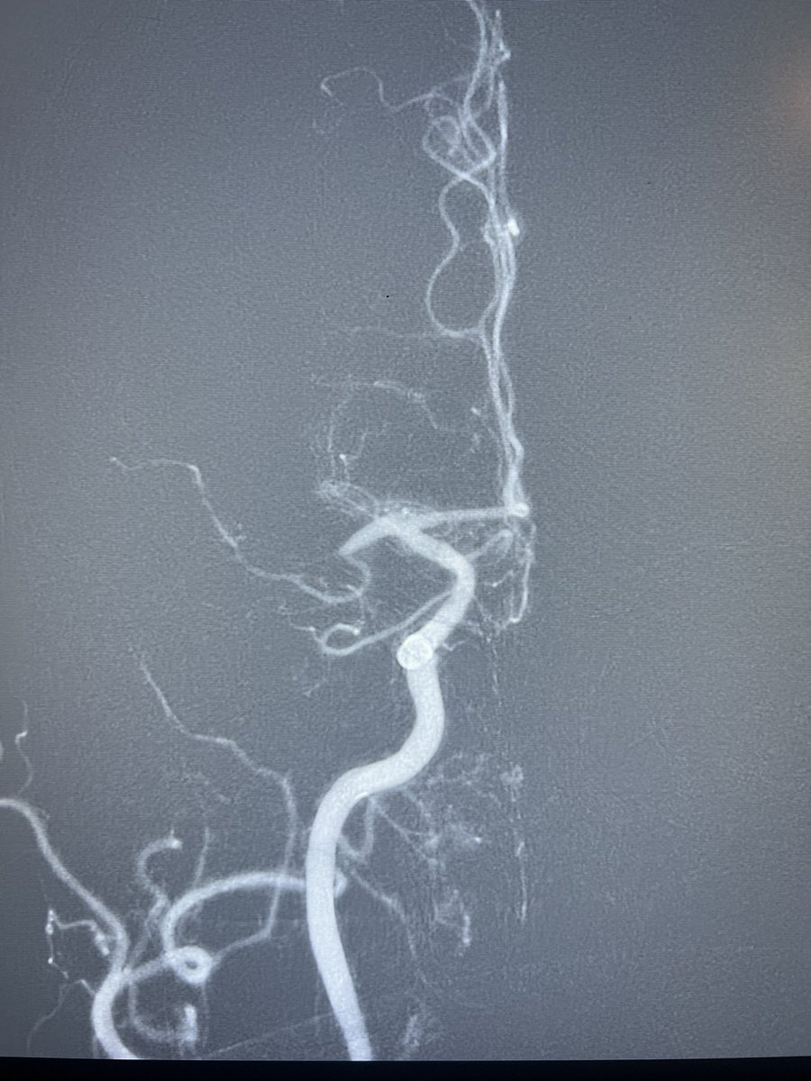 KenJohnsonMD's tweet photo. Back-to-back 12 minutes and 9 minutes thrombectomies with #SendiT @PenNeuro @TulaneNeuro https://t.co/xqPN3JijJW