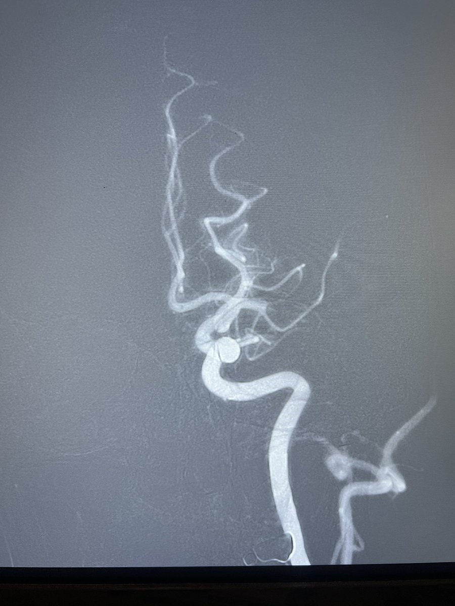 KenJohnsonMD's tweet photo. Back-to-back 12 minutes and 9 minutes thrombectomies with #SendiT @PenNeuro @TulaneNeuro https://t.co/xqPN3JijJW