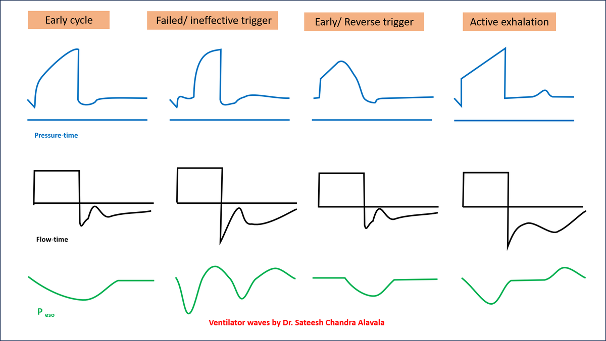 DrSateeshPCCM's tweet photo. An upward deflection in the expiratory flow-time graph can suggest a reduction in expiratory flow due to the patient's inspiratory effort. Early cycling, a common patient-ventilator dyssynchrony, often manifests as an upward deflection in the initial phase of the expiratory flow https://t.co/Ekzh83JMma