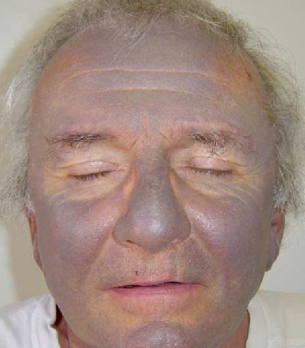 This patient has Atrial fibrillation, 

What medication is he taking ?