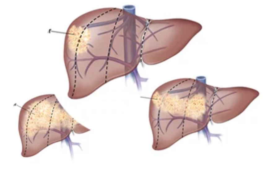 asscatinforma's tweet photo. ❗Identifican potenciales dianas para tratar el cáncer de hígado infantil más frecuente.  Se trata de un estudio del @CIBERehd con participación del @IBSAL_IIS, publicado en @JHepatology 👉 https://t.co/aCTBLsSWoc

#Hepatoblastoma https://t.co/dgcvLUVh9a