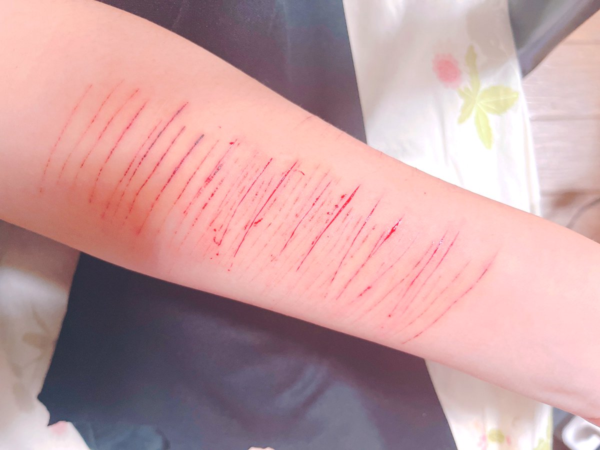 EimRyp's tweet photo. 😆👎
#リスカ #リスカ画像 #アムカ
#自傷垢  #病み垢さんフォロバ
#病み垢さんと繋がりたい https://t.co/u9U8vFSrjk