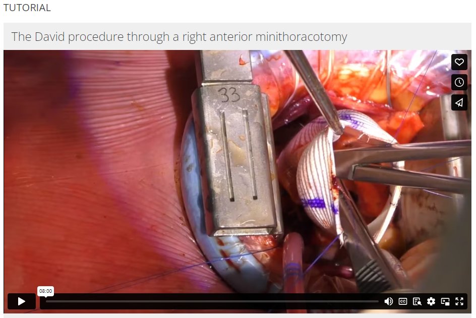 Here is my first MMCTS tutorial. The David procedure through right anterior minithoracotomy.
mmcts.org/tutorial/1835 
@MMCTS_Manual #surgery 
The next tutorial is coming soon