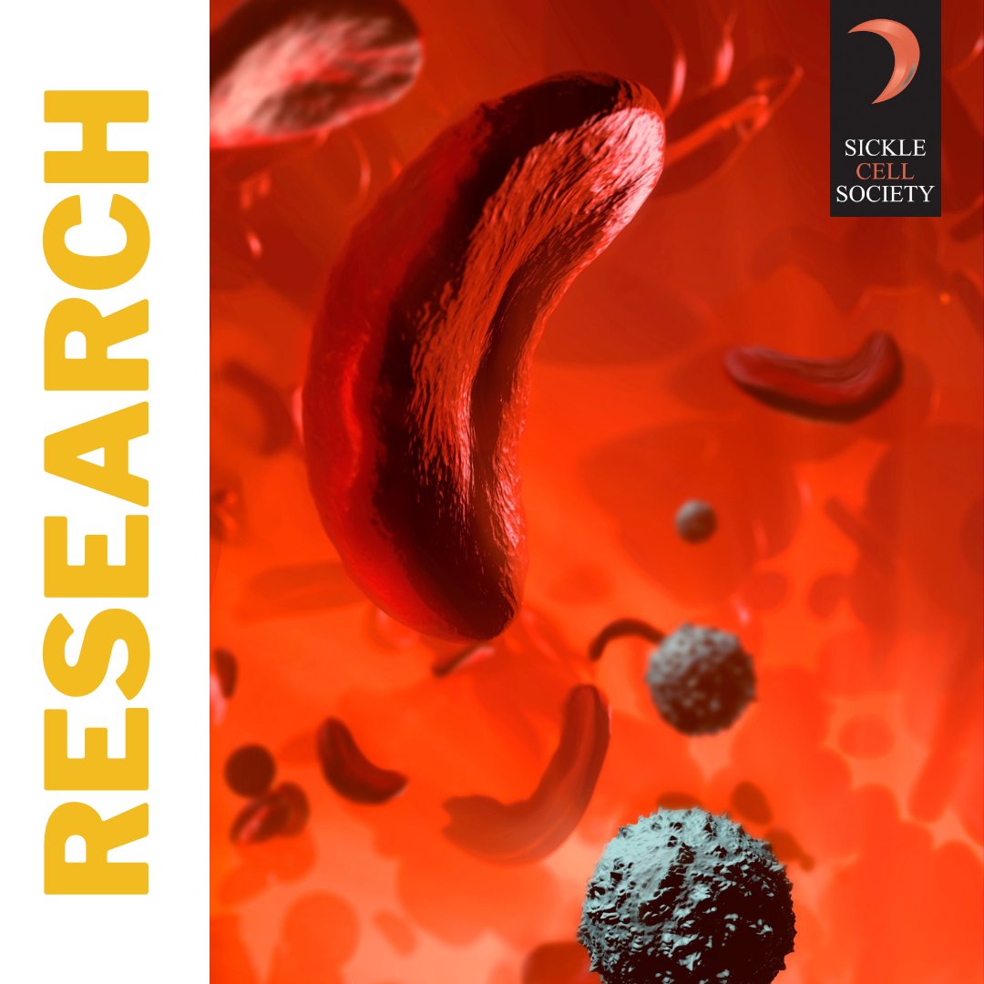 Researchers at King’s College London, King’s College Hospital + SCS are doing a project with young people with #sicklecell to develop tools that enable them to be involved in research. Email Jane Chudleigh (jane.2.chudleigh@kcl.ac.uk) or Pru Holder (pru.holder@kcl.ac.uk) for info