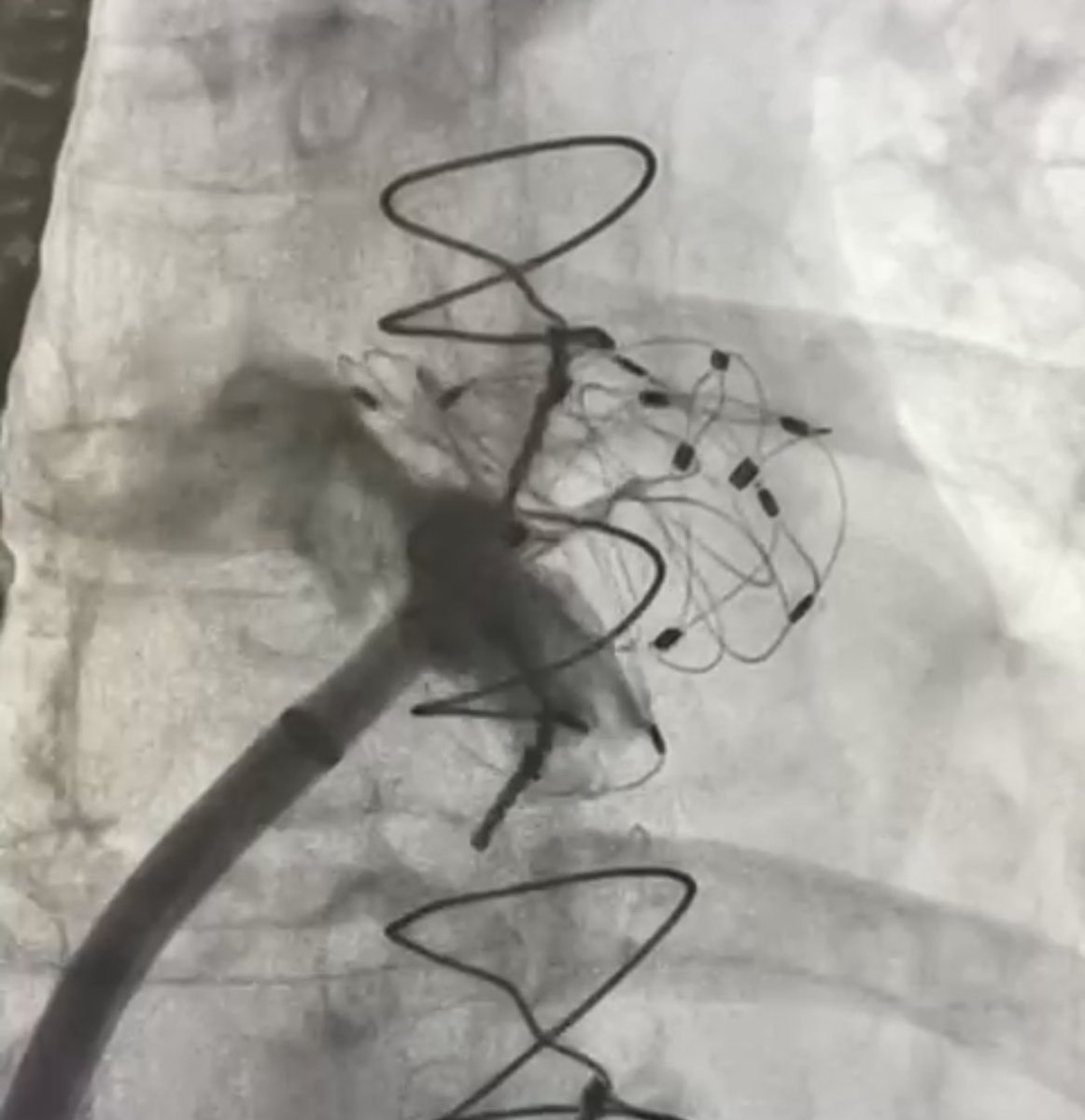 Interesting day of #LAAO at <a href="/HUdeTorrejon/">Hospital Universitario de Torrejón</a> with <a href="/CardiaInc/">Cardia</a> #Ultraseal device.
We had to tackle 2 cases with challenging chicken wing anatomies (one reverse and one conventional).
Both could be successfully solved using a “sandwich technique” in a smooth and straightforward manner