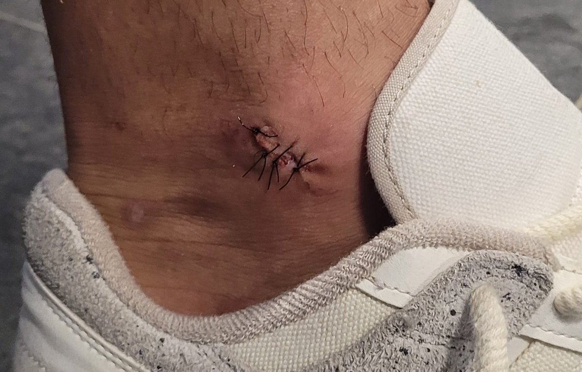 1 PUNTO PARA EL PIRATA, 4 PARA EL INTENDENTE 
Lucas Passerini se fue de Alberdi con 4 puntos de sutura en su pie derecho. 
Ni el árbitro ni al VAR decidieron cobrar un falta en el área al delantero, en lo que podría haber sido el 2-0 para #Belgrano

📷 <a href="/SebaVargas76/">Seba Vargas</a>