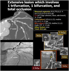 Journal of Cardiovascular CT (@journalcct) on Twitter photo Research published in <a href="/journalCCT/">Journal of Cardiovascular CT</a> updates the #SYNTAX score for coronary artery bypass graft #CABG surgery to non-invasive #CCTA. This is used to optimally plan/execute CABG surgery for patients w/ #complexCAD coronary artery disease.
Learn more: sciencedirect.com/science/articl… #yesCC Research published in <a href="/journalCCT/">Journal of Cardiovascular CT</a> updates the #SYNTAX score for coronary artery bypass graft #CABG surgery to non-invasive #CCTA. This is used to optimally plan/execute CABG surgery for patients w/ #complexCAD coronary artery disease.
Learn more: sciencedirect.com/science/articl… #yesCC