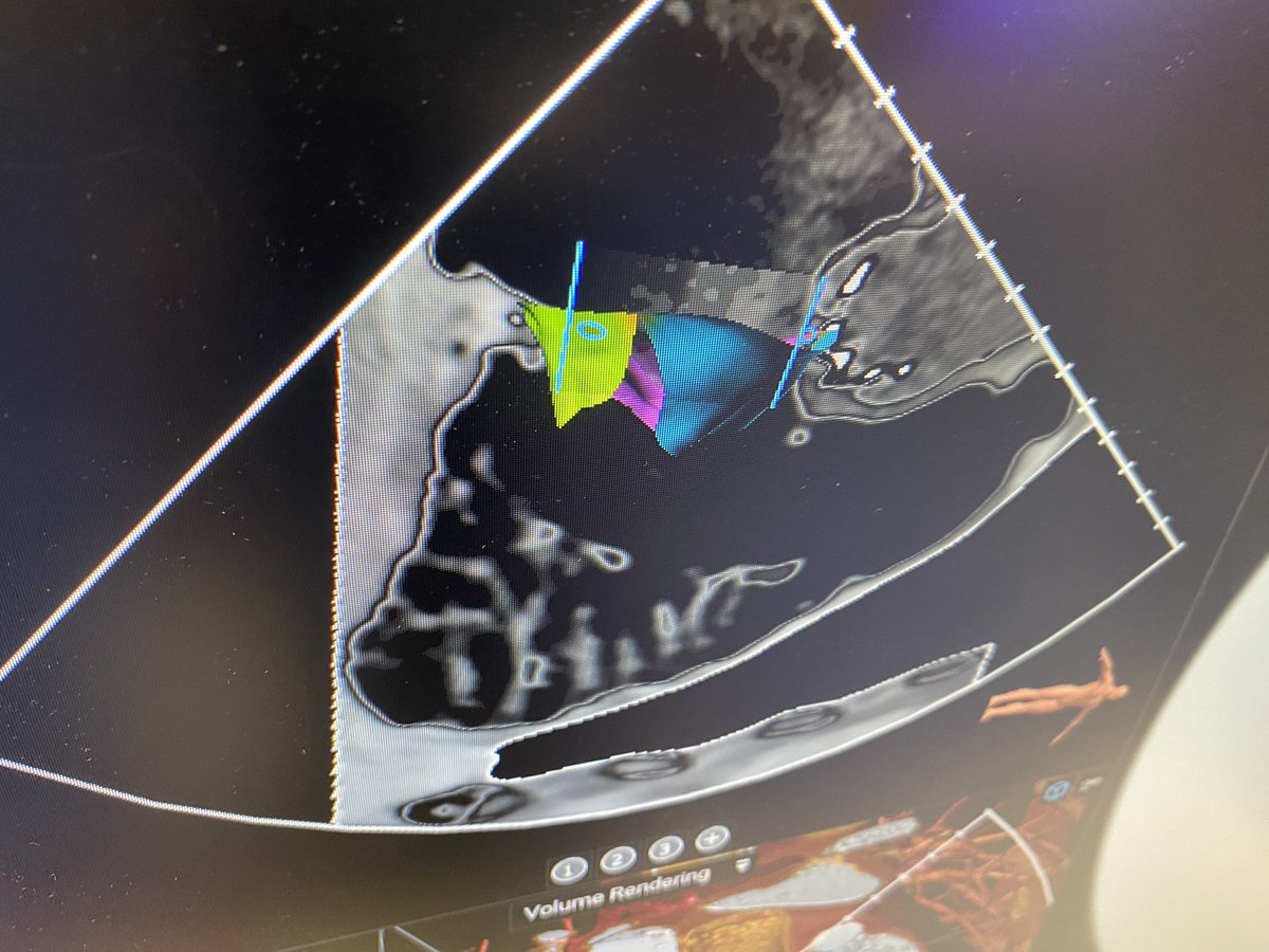 This is an example of the 3mensio transcatheter tricuspid valve implantation planning software demonstrated at #TCT2023 it uses a patient CT scan to help make measures. These photos show how the software can show the angles needed to various ICE views. #cardiotwitter