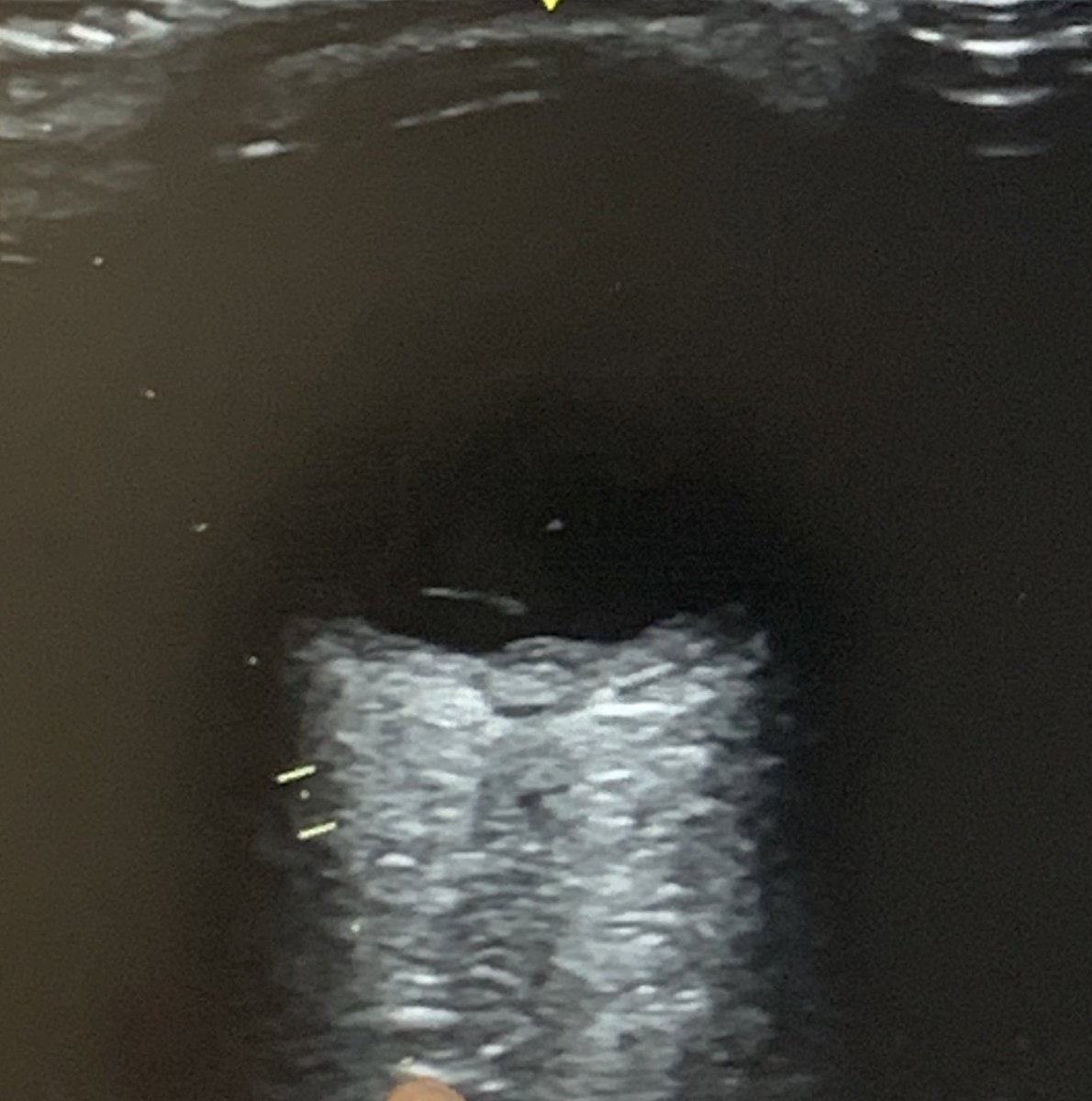 Been playing  with ultrasound lately, with heartbreaking findings💔