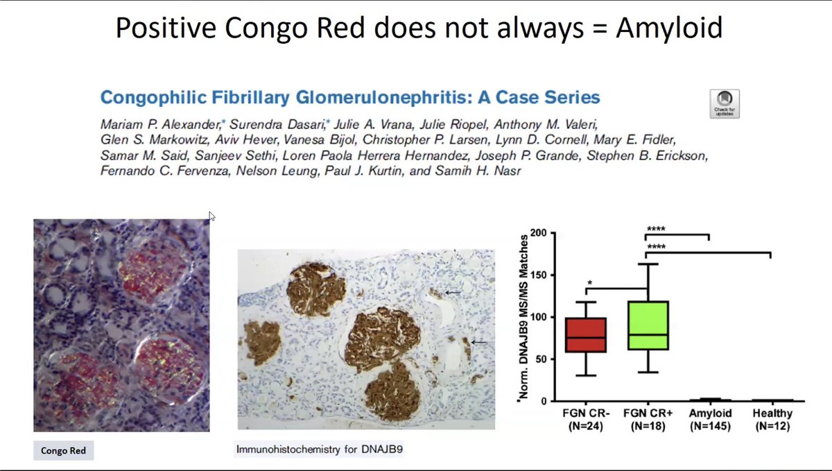 DrSumanBehera's tweet photo. 🍎🍏Absence of Congo red staining
🚫Not too sensitive to distinguish FGN vs Amyloidosis
👩🏻🔬Other diagnostic methods:
🧩Mass spectrometry
🧩Immunohistochemistry
🧪#DNAJB9 help in the DIAGNOSIS
https://t.co/w42FK09D5v
#ECNeph @DrSumanBehera @myadla @Tiff_Caza @ISNkidneycare https://t.co/WveBXwFvpt