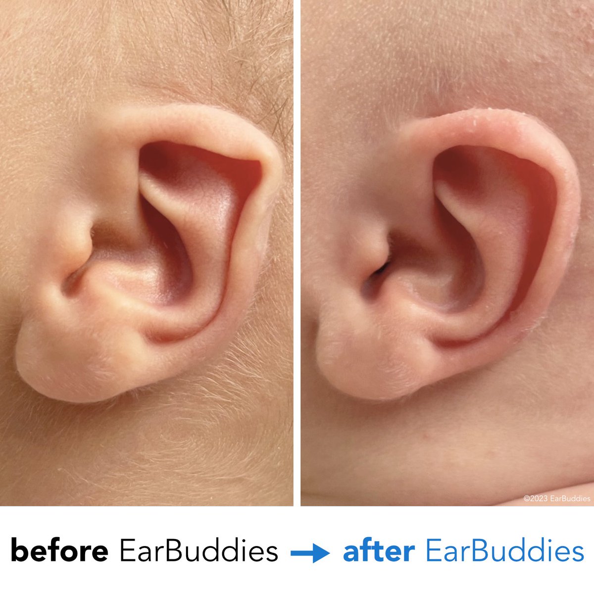 EarBuddies's tweet photo. Artur from Scotland corrected his son Kai's ear with @EarBuddies in just 2 weeks • “It was easy enough to follow the instructions on how to install #EarBuddies and we’ve seen great results within two weeks of usage.” Read his story here: https://t.co/Y3PEKhRbNQ #earcorrection https://t.co/ExhQLJgYhA